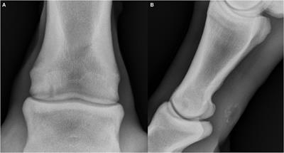 Radiographic prevalence of juvenile osteochondral conditions of the proximal interphalangeal joint of Australian Thoroughbred racehorse yearlings and associations with sales results and race performance